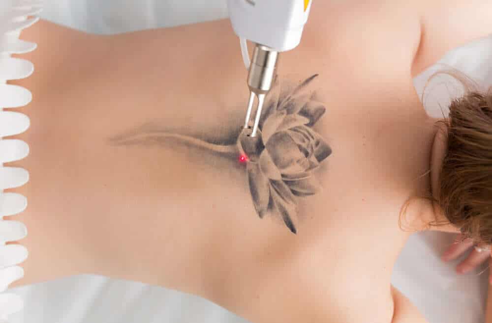 Czy można całkowicie usunąć tatuaż?